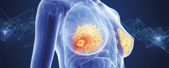 Breast Cancer : जानें ब्रेस्ट कैंसर की पहचान करने के 5 तरीके