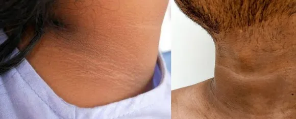 Dark Neck: काली गर्दन से छुटकारा पाने के लिए जानें कुछ घरेलू उपाय