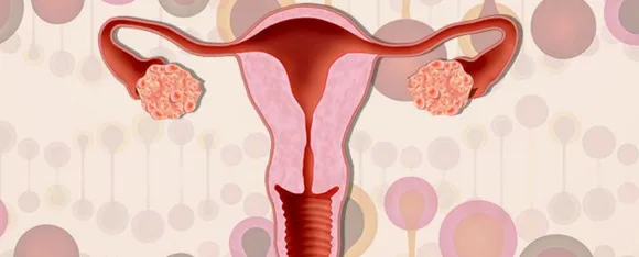 PCOS Myths : जानें पीसीओएस से जुड़े कुछ मिथक के‌‌ बारे में