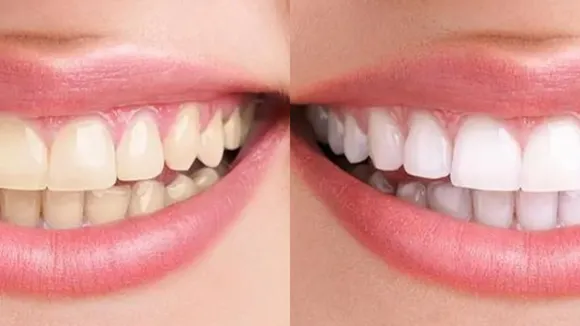 How to Get Rid of Yellow Teeth