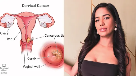 Cervical cancer