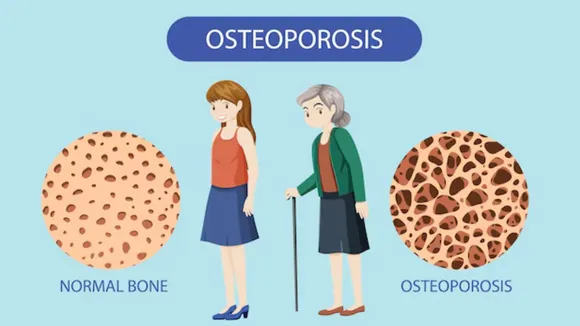 Osteoporosis
