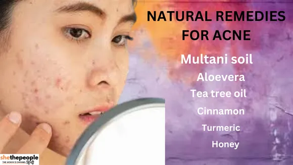 Natural Remedies: जानिए मुँहासे के लिए 7 असरदार नेचुरल रेमेडी