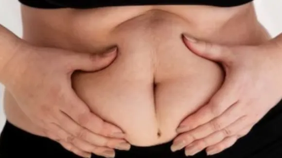 Stretch Marks से जुड़ी ये 6 बातें हर महिला को पता होनी चाहिए