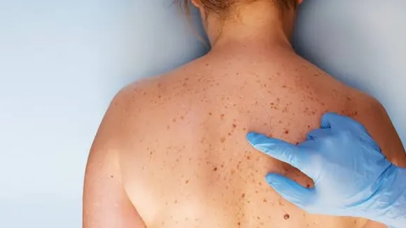 क्या आप भी Skin Cancer के लक्षणों को कर रहें है इग्नोर?