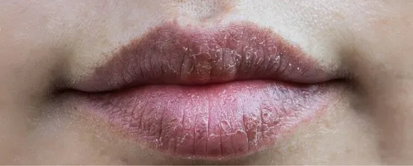 Dark Lips: हल्दी-मलाई के इस्तेमाल सहित जानें काले होंठ के उपाय
