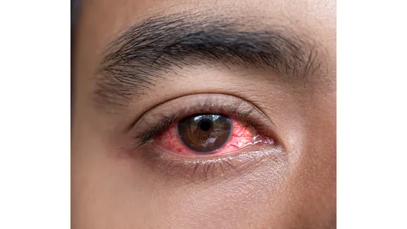 Redness Eyes: जानें आंखों की लालीपन को दूर करने के 5 बेहतरीन टिप्स