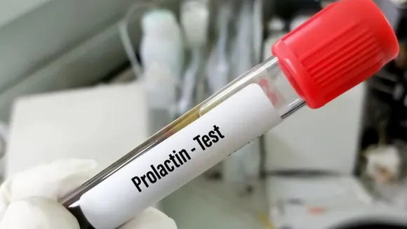 High Prolactin Level(freepik)