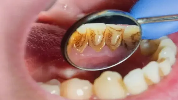 Pyorrhoea: दांतों में पायरिया समय रहते ठीक न कराने पर पड़ता है भारी