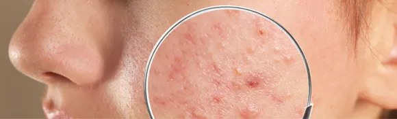 Acne: जानिए मुँहासे होने के 5 कारणों के बारे में