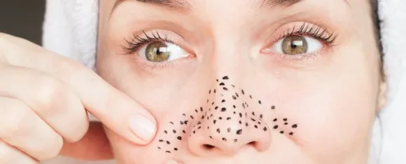 Blackheads : जानें चेहरे पर होने वाले ब्लैकहेड्स को कैसे रोके