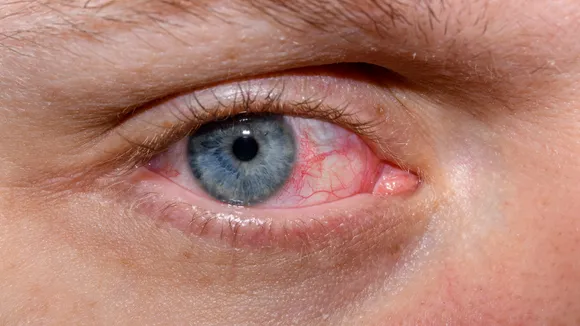 Eye Irritation and Itching : आंखों में होने वाले जलन से कैसे बचें?