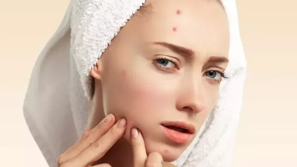 Pimples Issue: जानें क्यों आ जाते हैं चेहरे पर मुंहासे