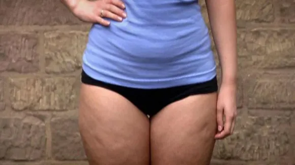 What is Lipedema: শরীরের নিচের অংশে ফ্যাট বৃদ্ধি লিপিডেমা রোগের ইঙ্গিত হতে পারে