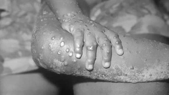 US confirms monkeypox infection