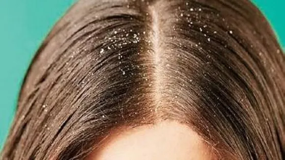 hair dandruff in summer days - গরমে খুসকি