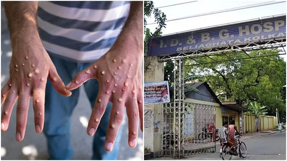 west bengal health dept issues guideline for monkeypox