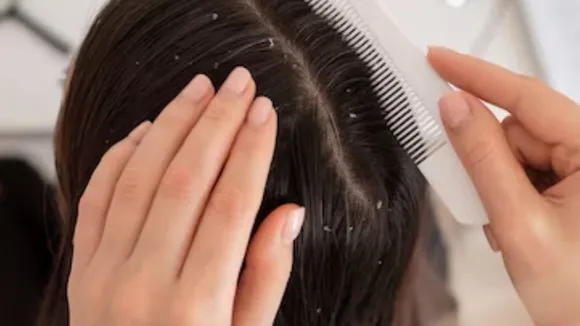 how to take care of hair in cold days to stop increasing dandruff during winter season