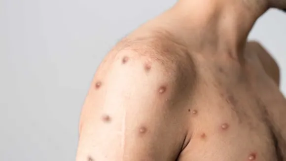 There are no reported cases of Monkeypox in India as of now, it said. mpox