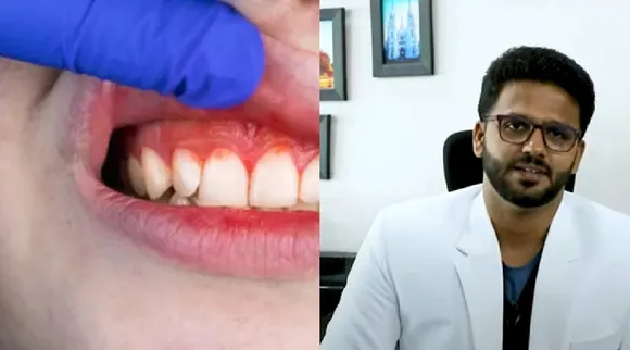 Bleeding Gums