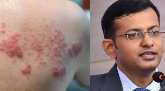 Rashes issue