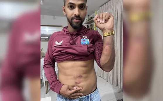 Kya bhayanak mara hain'- Fans react as Nicholas Pooran shows off his bruises caused by Brandon King after 5th T20I vs India
