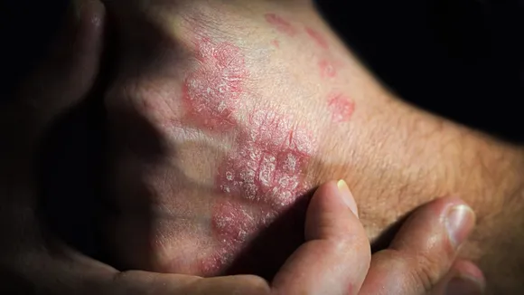 Alumis Secures $259 Million to Revolutionize Psoriasis Treatment with ESK-001