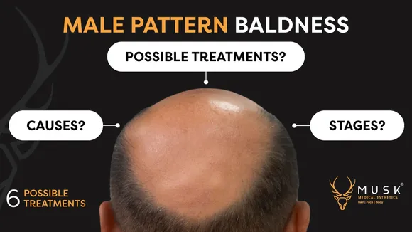 Navigating the Maze of Male Pattern Baldness: Understanding, Treatment, and Hope