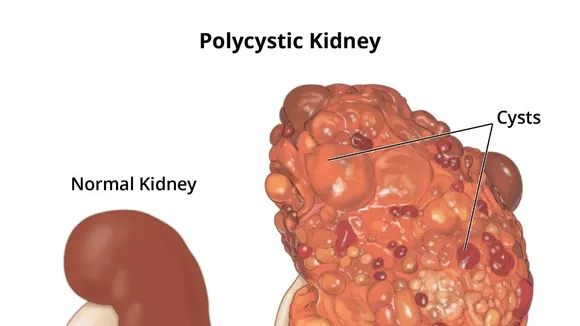 Deciphering Kidney Health: The Difference Between Cysts and Polycystic Kidney Disease