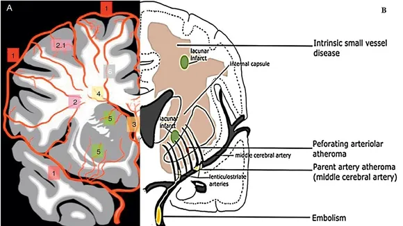 Unveiling the Shadows: The Intersection of Intracerebral Hemorrhage and Cerebral Small Vessel Disease