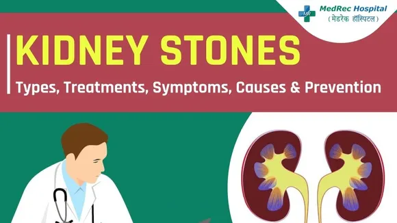 Navigating the Painful Passage: A Closer Look at Kidney Stones, Treatment, and Prevention