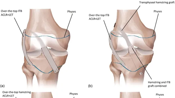 Pioneering Review on ACL Injury Treatments in Children Points to Anterolateral Augmentation as a Beacon of Hope