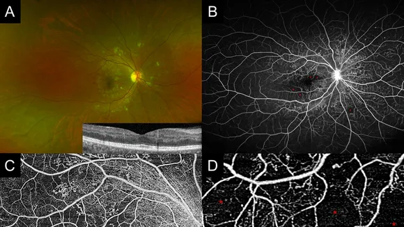 Unlocking the Future of Diabetic Retinopathy Management: The Critical Role of Retinal Non-Perfusion