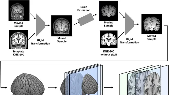 Revolutionizing Alzheimer's Detection: AI's Promising Horizon