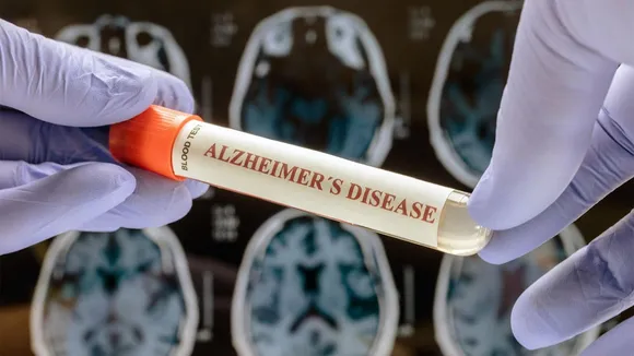 A Breakthrough in Alzheimer's Diagnosis: The Promise and Challenges of the p-Tau 217 Blood Test
