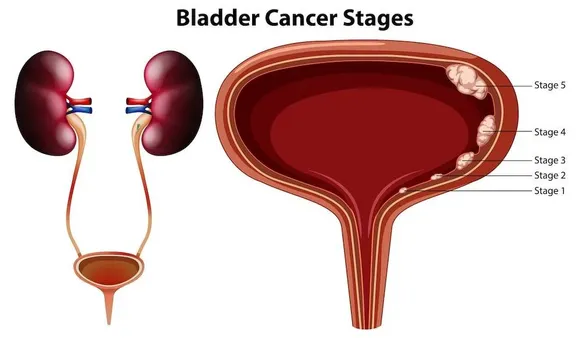 Life after Bladder Cancer: What to Expect