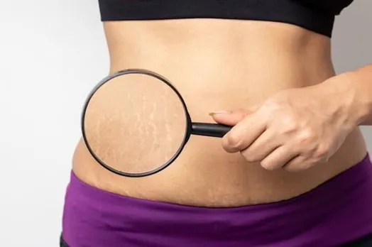 Belly Fat and Rashes: Unearthing the Connection
