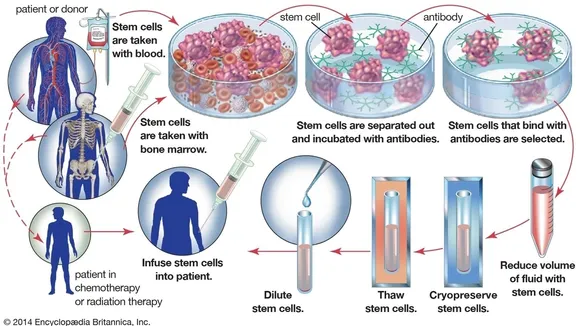 Emerging Bone Marrow Transplant Technology: A Beacon of Hope for Sickle Cell Patients