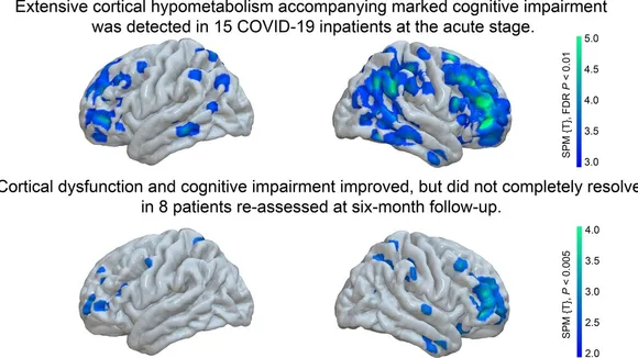 Unraveling the Connection Between Long COVID and Cognitive Slowing: A Recent Study's Insights