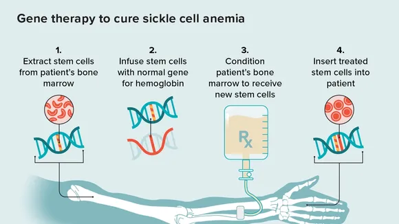 Sickle Cell Disease: The Potential of Pill-Based Treatment vs. Newly Approved Gene Therapies
