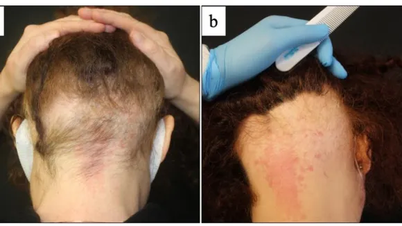 Exploring the Potential Link Between COVID-19 and Alopecia Areata
