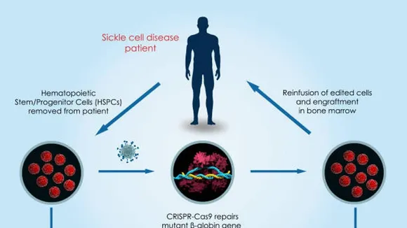CRISPR Technology: A Groundbreaking Cure for Sickle-Cell Disease