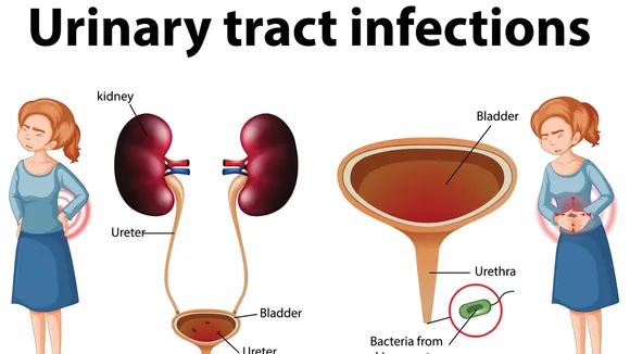 Understanding Urinary Tract Infections: Causes, Complications, and Treatment