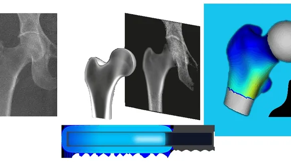 Revolutionizing Osteoporosis Diagnosis: 3D DXA Technology Paves the Way
