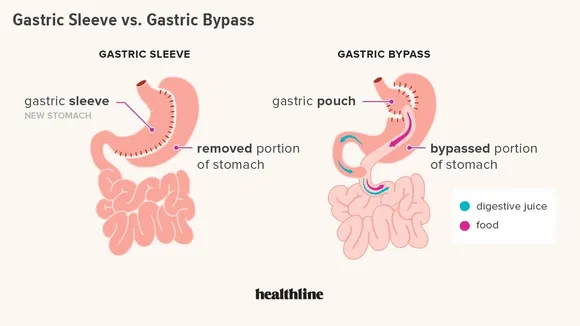 Comparative Study of Laparoscopic Sleeve Gastrectomy and Roux-en-Y Gastric Bypass: Perioperative Outcomes and Implications