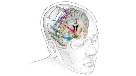 Deep Brain Stimulation: A New Ray of Hope for Treatment-Resistant Depression