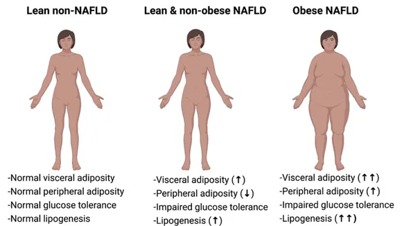 Understanding Fatty Liver Disease in Lean Individuals: New Insights and Predictive Models