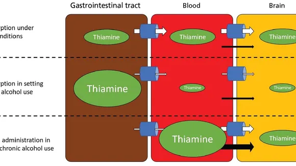 The Role of Thiamine Supplementation in Managing Septic Shock and Renal Complications