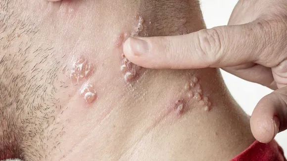 Understanding Shingles: Contagiousness, Transmission, and Protection