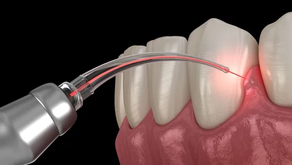 The Evolution and Advantages of Laser Dentistry: A Comprehensive Guide